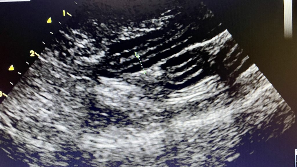 Gastrointestinal Disease